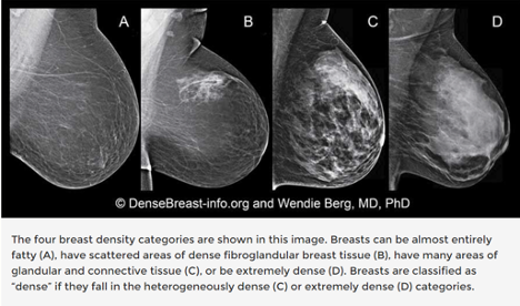 The Dense Breast Dilemma